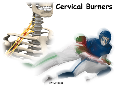 Cervical Burners and Stingers (Brachial Plexis Injuries)
